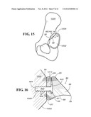 METHODS AND APPARATUS FOR FAI SURGERIES diagram and image