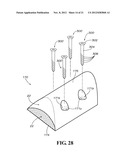 METHODS AND APPARATUS FOR FAI SURGERIES diagram and image