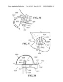 METHODS AND APPARATUS FOR FAI SURGERIES diagram and image