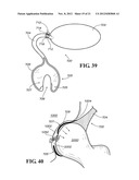 METHODS AND APPARATUS FOR FAI SURGERIES diagram and image