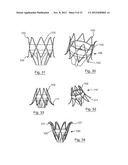 ESOPHAGEAL VALVE DEVICE FOR PLACING IN THE CARDIA diagram and image