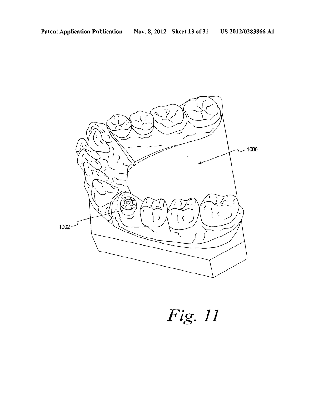 METHODS FOR PLACING AN IMPLANT ANALOG IN A PHYSICAL MODEL OF THE PATIENT'S     MOUTH - diagram, schematic, and image 14