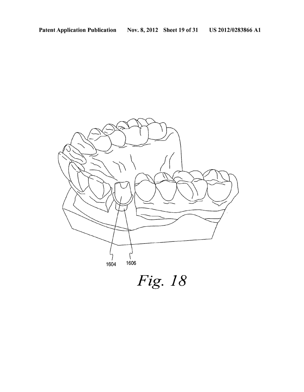 METHODS FOR PLACING AN IMPLANT ANALOG IN A PHYSICAL MODEL OF THE PATIENT'S     MOUTH - diagram, schematic, and image 20