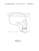 Bone Plate Manufacturing Method diagram and image