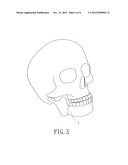 Bone Plate Manufacturing Method diagram and image