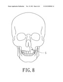 Bone Plate Manufacturing Method diagram and image