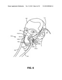 NASAL PASSAGE OPENER OF A VENTILATION MASK diagram and image