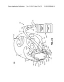 NASAL PASSAGE OPENER OF A VENTILATION MASK diagram and image