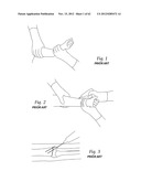 SYSTEMS, DEVICES, AND METHODS FOR MECHANICALLY REDUCING AND FIXING BONE     FRACTURES diagram and image