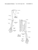 SYSTEMS, DEVICES, AND METHODS FOR MECHANICALLY REDUCING AND FIXING BONE     FRACTURES diagram and image