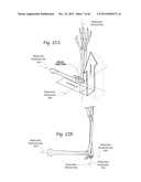 SYSTEMS, DEVICES, AND METHODS FOR MECHANICALLY REDUCING AND FIXING BONE     FRACTURES diagram and image