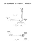 SYSTEMS, DEVICES, AND METHODS FOR MECHANICALLY REDUCING AND FIXING BONE     FRACTURES diagram and image