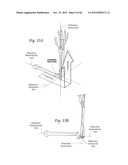 SYSTEMS, DEVICES, AND METHODS FOR MECHANICALLY REDUCING AND FIXING BONE     FRACTURES diagram and image