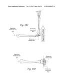 SYSTEMS, DEVICES, AND METHODS FOR MECHANICALLY REDUCING AND FIXING BONE     FRACTURES diagram and image