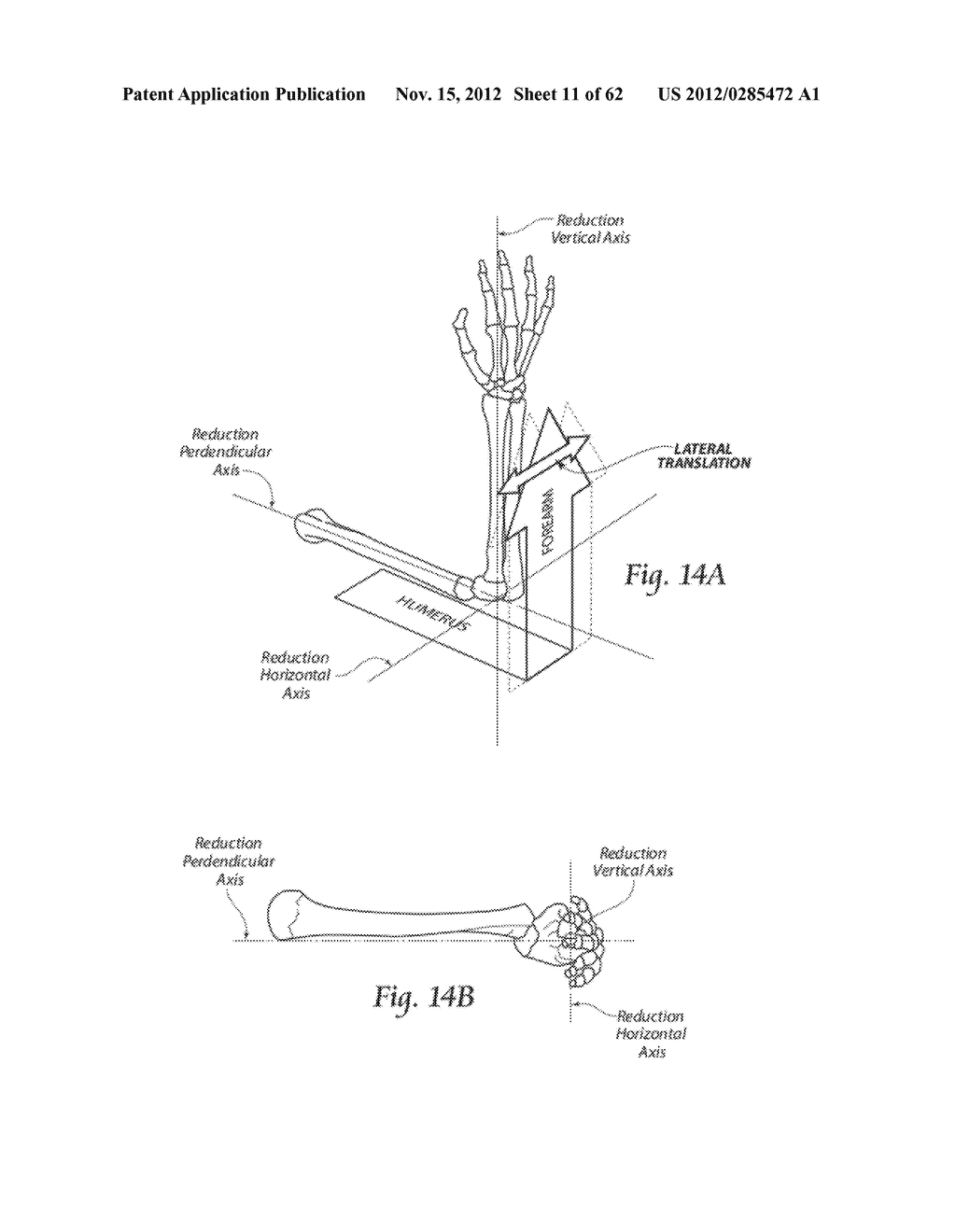 SYSTEMS, DEVICES, AND METHODS FOR MECHANICALLY REDUCING AND FIXING BONE     FRACTURES - diagram, schematic, and image 12