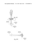 SYSTEMS, DEVICES, AND METHODS FOR MECHANICALLY REDUCING AND FIXING BONE     FRACTURES diagram and image