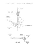 SYSTEMS, DEVICES, AND METHODS FOR MECHANICALLY REDUCING AND FIXING BONE     FRACTURES diagram and image