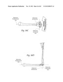 SYSTEMS, DEVICES, AND METHODS FOR MECHANICALLY REDUCING AND FIXING BONE     FRACTURES diagram and image