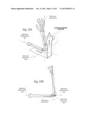 SYSTEMS, DEVICES, AND METHODS FOR MECHANICALLY REDUCING AND FIXING BONE     FRACTURES diagram and image