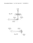 SYSTEMS, DEVICES, AND METHODS FOR MECHANICALLY REDUCING AND FIXING BONE     FRACTURES diagram and image