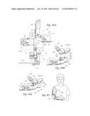 SYSTEMS, DEVICES, AND METHODS FOR MECHANICALLY REDUCING AND FIXING BONE     FRACTURES diagram and image