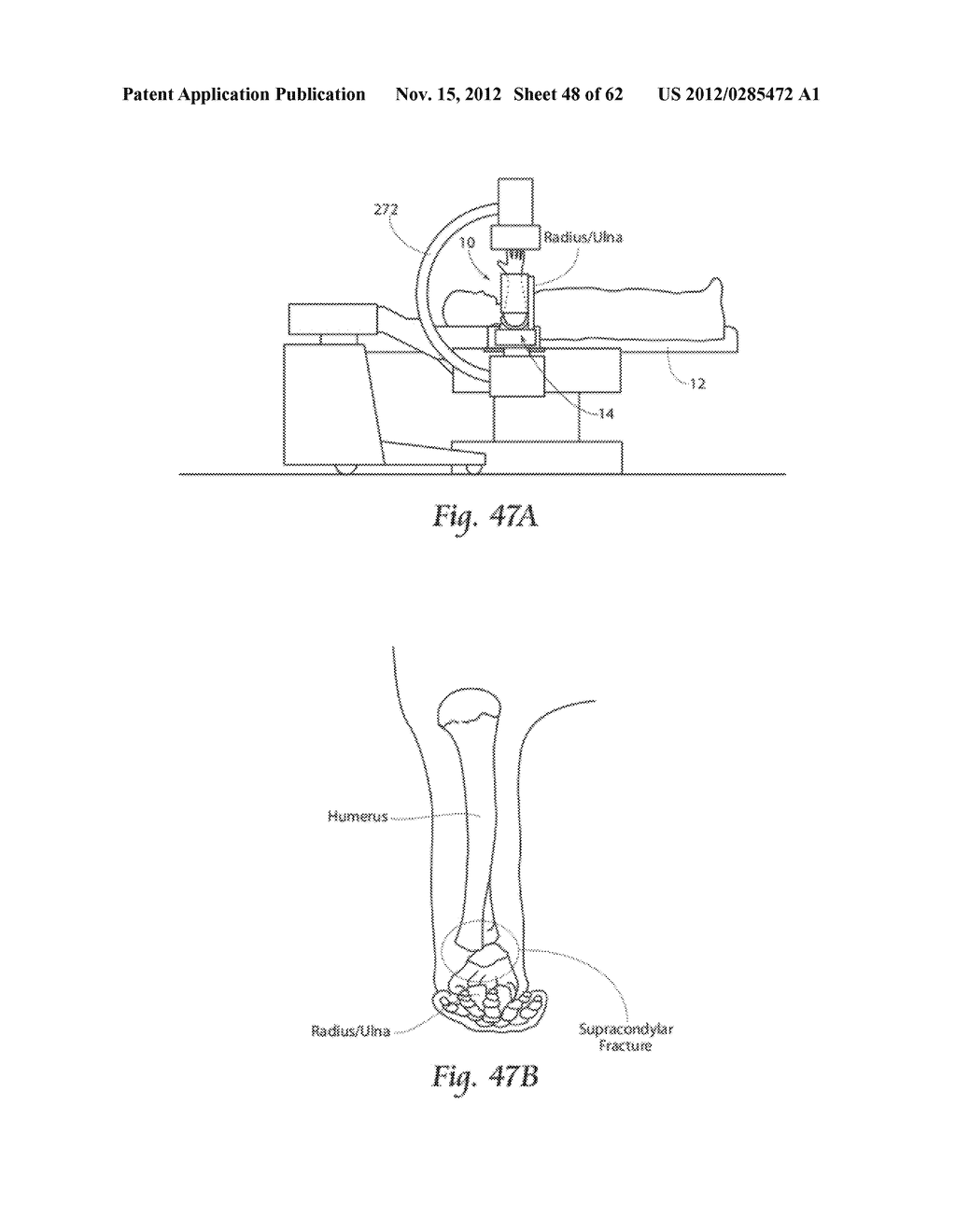 SYSTEMS, DEVICES, AND METHODS FOR MECHANICALLY REDUCING AND FIXING BONE     FRACTURES - diagram, schematic, and image 49