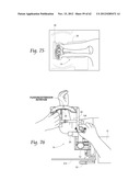 SYSTEMS, DEVICES, AND METHODS FOR MECHANICALLY REDUCING AND FIXING BONE     FRACTURES diagram and image