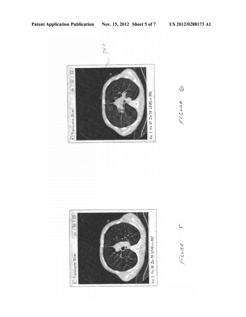 SURGICAL ASSISTANCE PLANNING METHOD USING LUNG MOTION ANALYSIS - diagram, schematic, and image 06