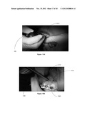 METHOD AND DEVICE FOR CAUSING TOOTH MOVEMENT diagram and image