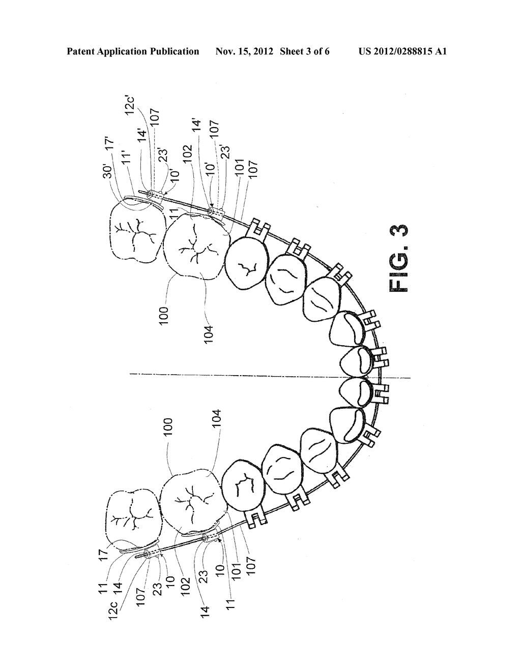  BONDABLE MOLAR TUBE - diagram, schematic, and image 04