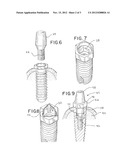 Dental Implants and Methods for Their Insertion into Patients diagram and image