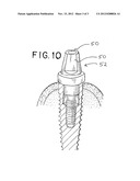 Dental Implants and Methods for Their Insertion into Patients diagram and image