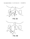 DELIVERY MEMBERS FOR DELIVERING AN IMPLANT INTO A BODY OF A PATIENT diagram and image