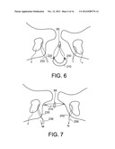 DELIVERY MEMBERS FOR DELIVERING AN IMPLANT INTO A BODY OF A PATIENT diagram and image