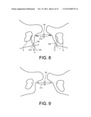 DELIVERY MEMBERS FOR DELIVERING AN IMPLANT INTO A BODY OF A PATIENT diagram and image
