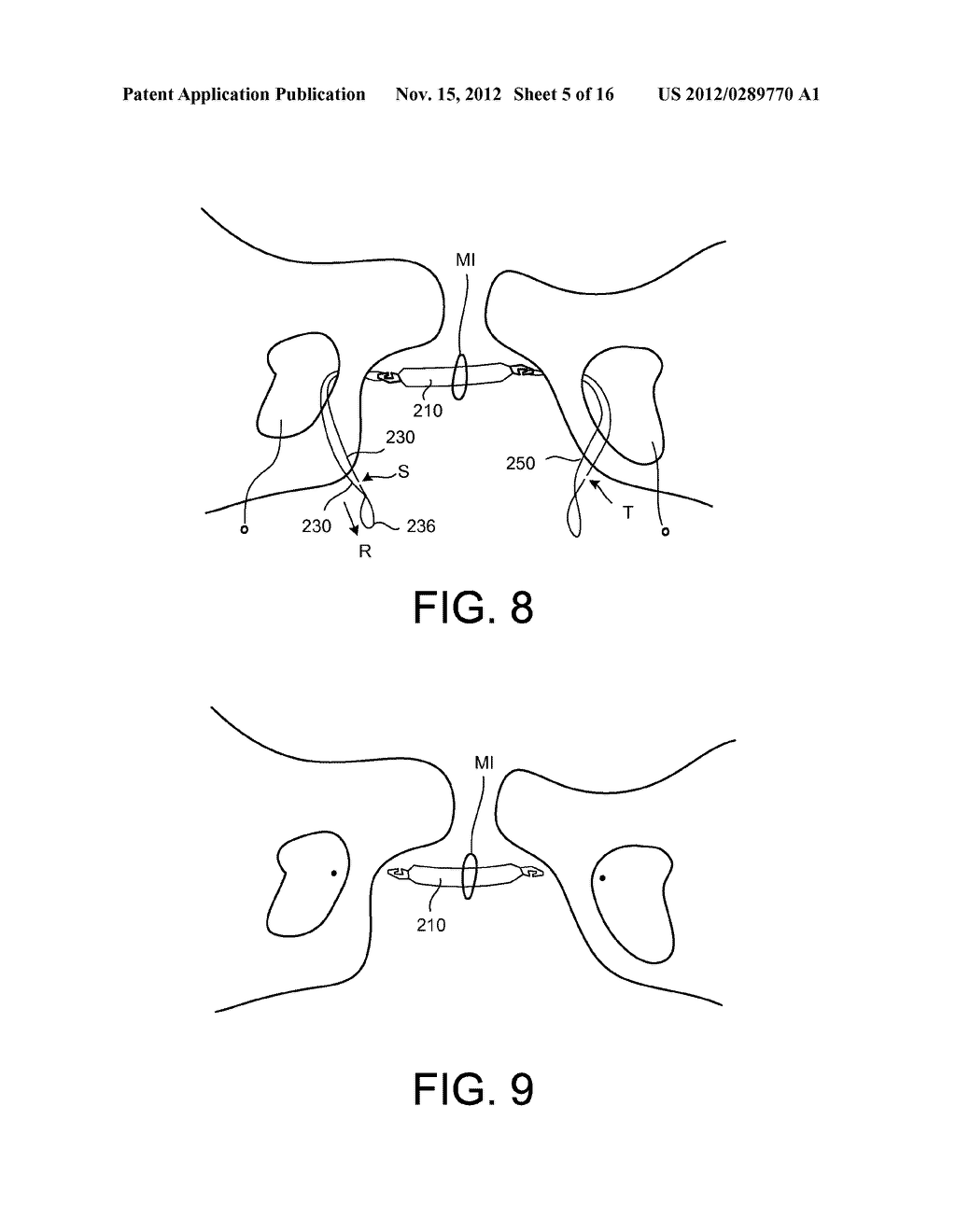 DELIVERY MEMBERS FOR DELIVERING AN IMPLANT INTO A BODY OF A PATIENT - diagram, schematic, and image 06