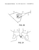 DELIVERY MEMBERS FOR DELIVERING AN IMPLANT INTO A BODY OF A PATIENT diagram and image