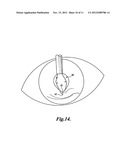 EXTENSION RING FOR EYEBALL TISSUE diagram and image