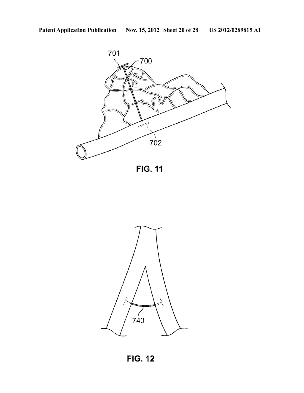 METHODS AND DEVICES FOR DIAGNOSING, MONITORING, OR TREATING MEDICAL     CONDITIONS THROUGH AN OPENING THROUGH AN AIRWAY WALL - diagram, schematic, and image 21