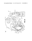 CARBON-DIOXIDE SAMPLING DEVICE FOR NONINVASIVELY MEASURING CARBON DIOXIDE     IN EXHALED BREATH diagram and image