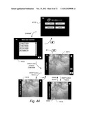 METHOD AND APPARATUS FOR HYSTEROSCOPY AND ENDOMETRIAL BIOPSY diagram and image