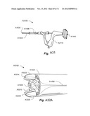 METHOD AND APPARATUS FOR HYSTEROSCOPY AND ENDOMETRIAL BIOPSY diagram and image