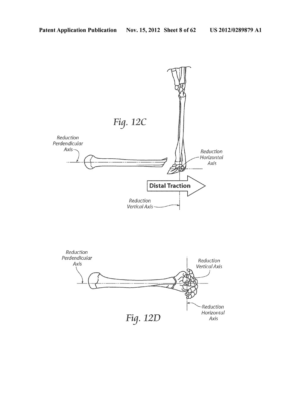 SYSTEMS, DEVICES, AND METHODS FOR MECHANICALLY REDUCING AND FIXING BONE     FRACTURES - diagram, schematic, and image 09