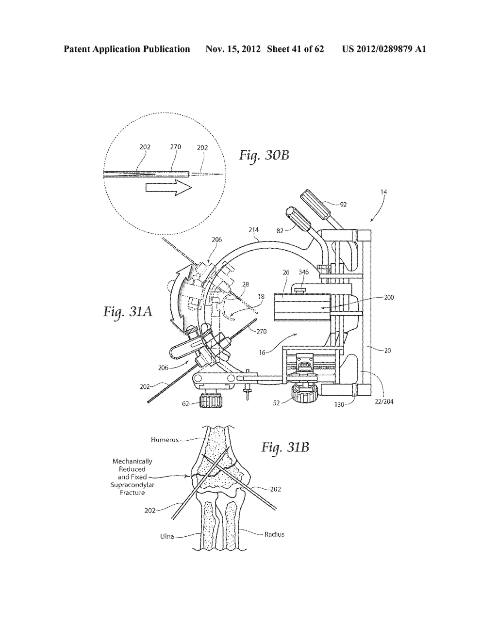 SYSTEMS, DEVICES, AND METHODS FOR MECHANICALLY REDUCING AND FIXING BONE     FRACTURES - diagram, schematic, and image 42