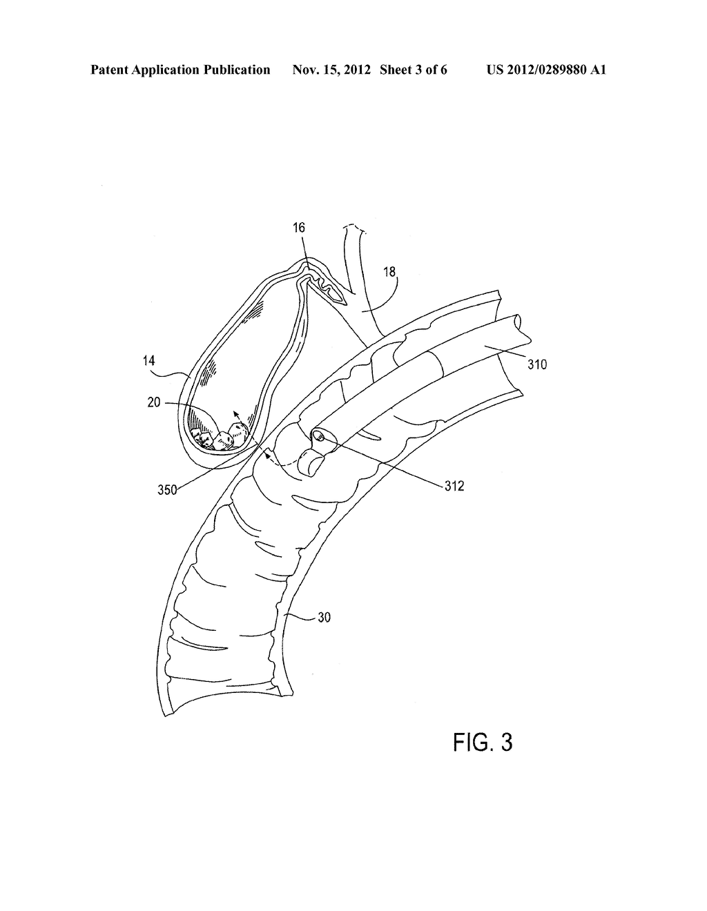 Methods, Devices, Kits and Systems for Defunctionalizing the Cystic Duct - diagram, schematic, and image 04