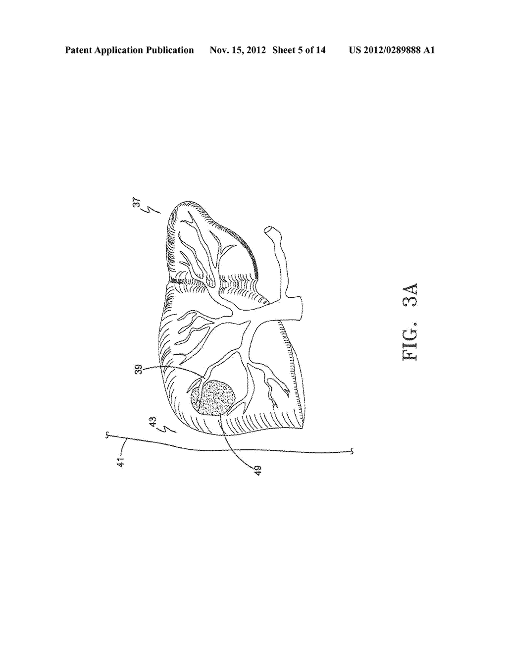 Irreversible Electroporation and Tissue Regeneration - diagram, schematic, and image 06