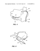 MULTI-BEND STEERABLE MAPPING CATHETER diagram and image