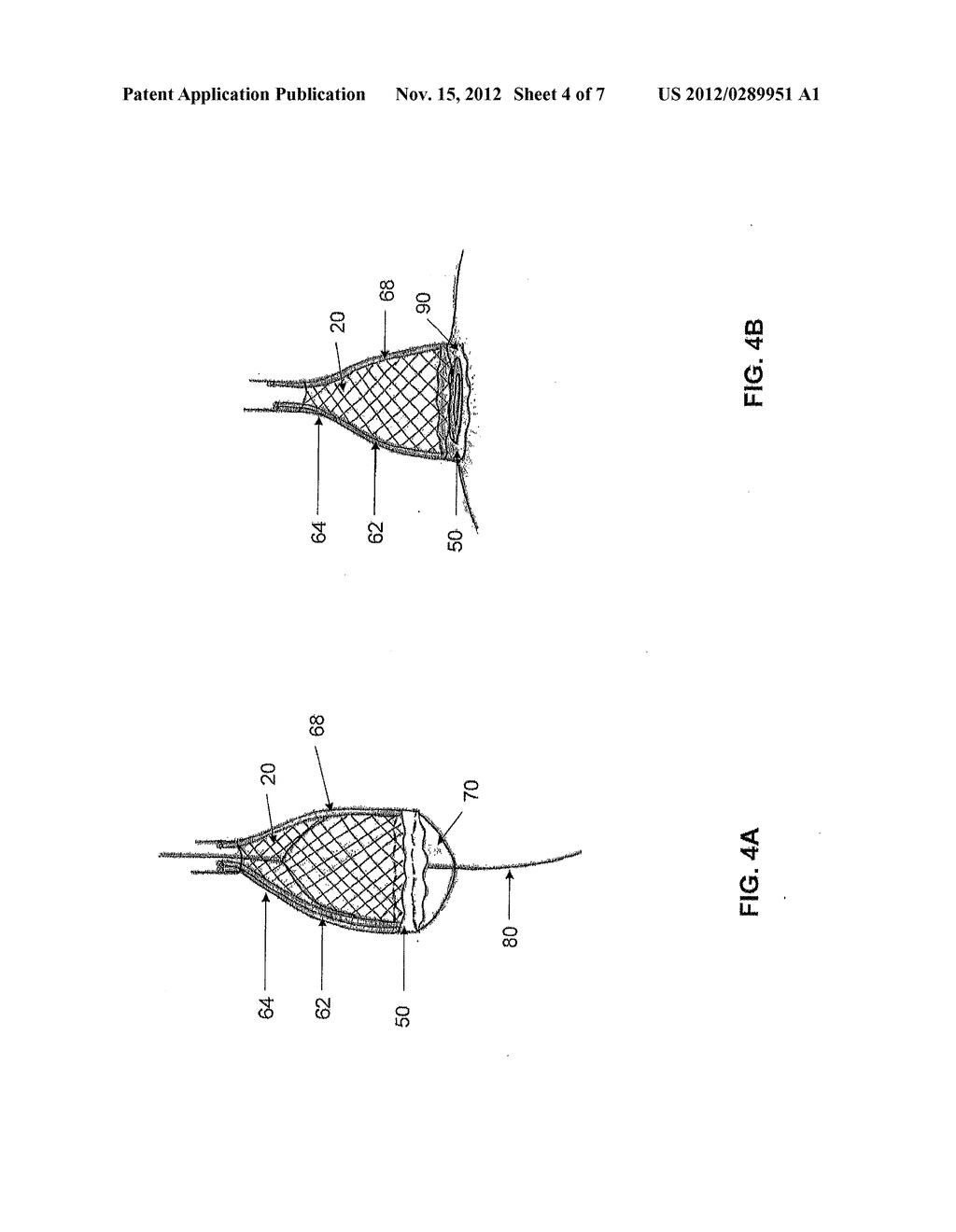 SYSTEMS AND METHODS FOR CRYOBLATION OF A TISSUE - diagram, schematic, and image 05