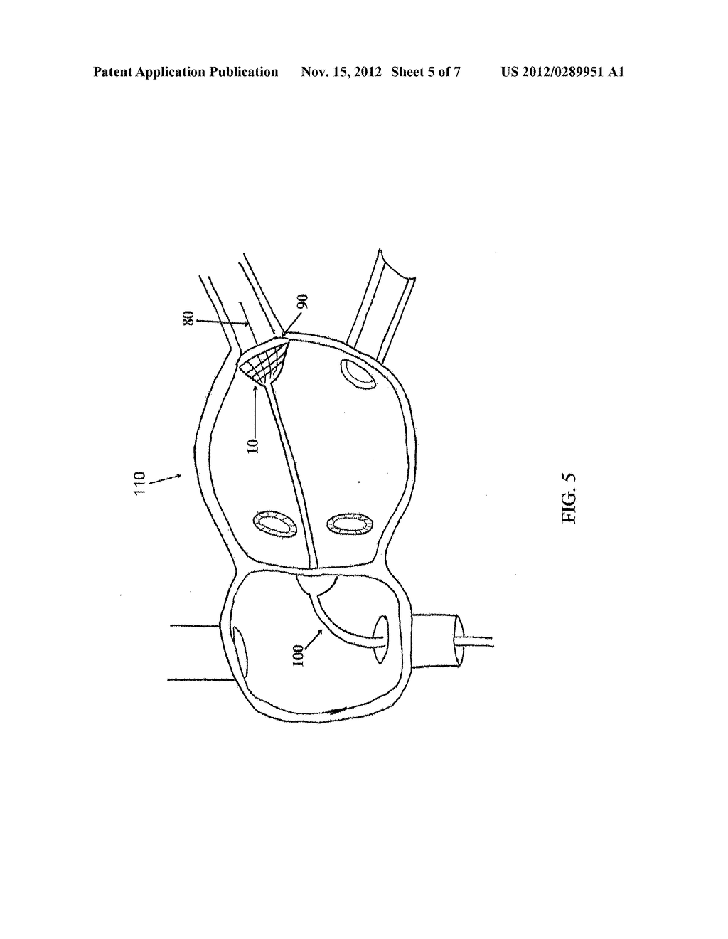 SYSTEMS AND METHODS FOR CRYOBLATION OF A TISSUE - diagram, schematic, and image 06