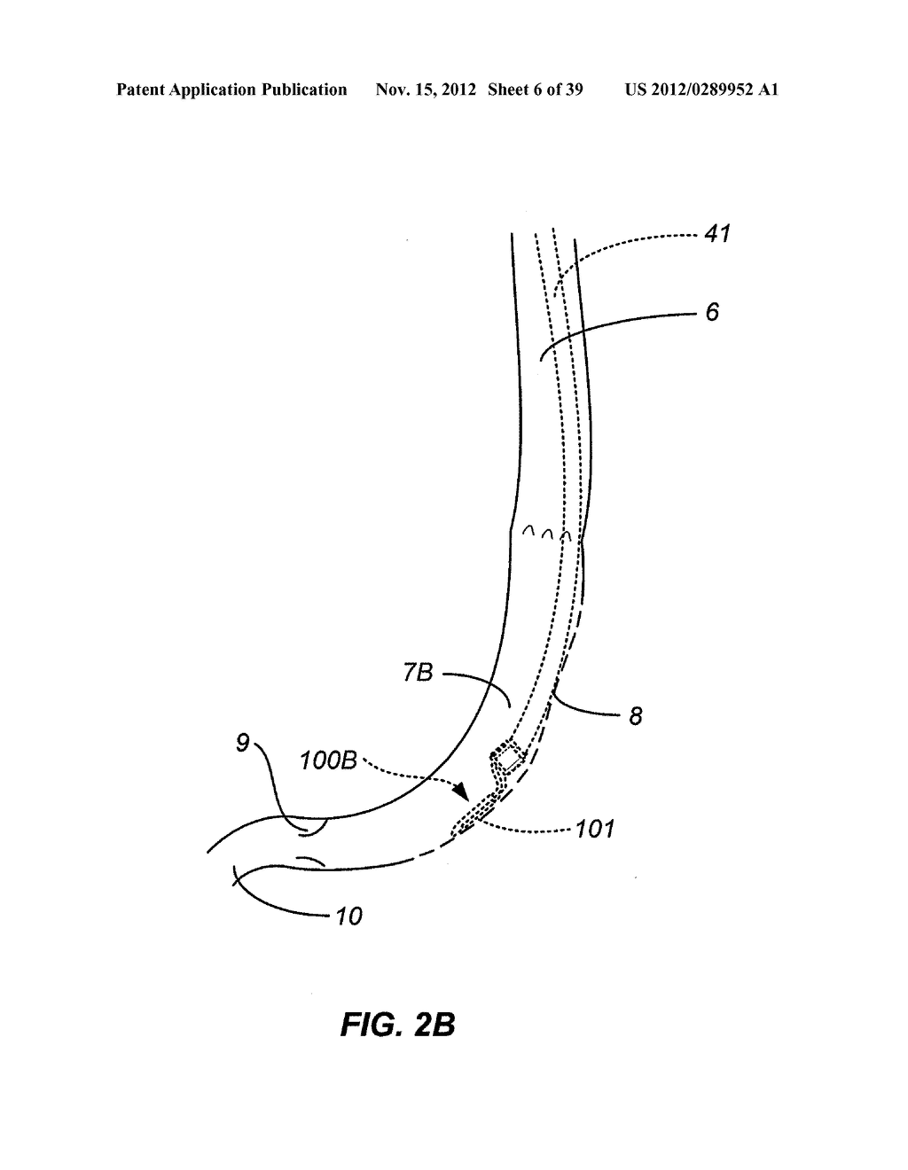 METHOD AND APPARATUS FOR GASTROINTESTINAL TRACT ABLATION TO ACHIEVE LOSS     OF PERSISTENT AND/OR RECURRENT EXCESS BODY WEIGHT FOLLOWING A WEIGHT LOSS     OPERATION - diagram, schematic, and image 07